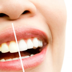Gigi Bebas Noda dengan Moeloet Whitening Strips: Cocok untuk Peminum Kopi dan Teh
