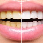 Moeloet Charcoal Whitening Strips: Kombinasi Minyak Kelapa dan Activated Charcoal untuk Memutihkan Gigi