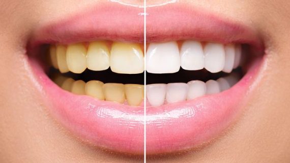 Coba Moeloet Whitening Foam untuk Mendapatkan Gigi yang Bersinar