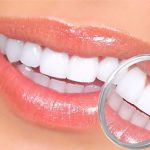 Moeloet Whitening Strips: Gigi Cerah dalam Waktu Singkat