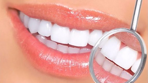 Moeloet Whitening Strips: Gigi Cerah dalam Waktu Singkat