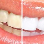 Moeloet Whitening Strips: Mudah Digunakan dan Hasil Terlihat dalam 8-10 Hari
