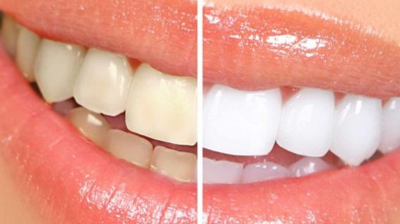 Moeloet Whitening Strips: Mudah Digunakan dan Hasil Terlihat dalam 8-10 Hari